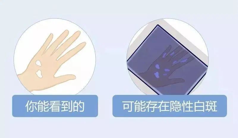 小孩手部皮肤有块白斑